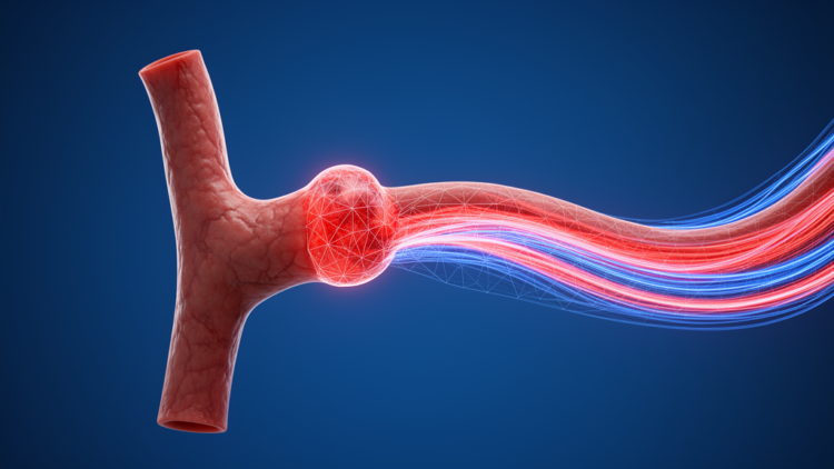 Physics-informed AI reduces errors in aneurysm flow reconstructions