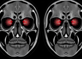 AI Maps Facial Tissue Depths in Nearly 2,000 CT Scans to Help Identify the Dead