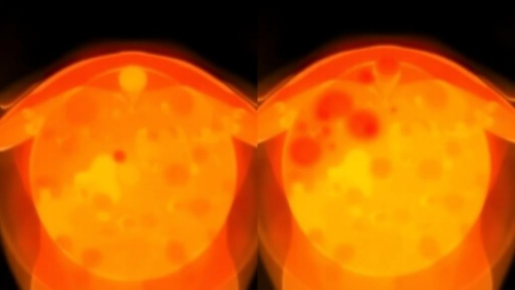 PSMA PET reveals uneven prostate-bed recurrence after prostatectomy