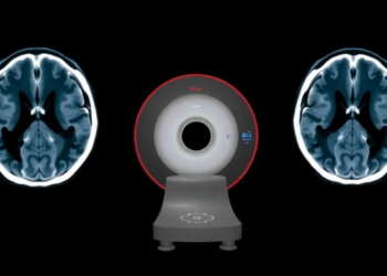 Ultra-Powerful 7-Tesla MRI Outperforms CT Scans in Measuring Brain Artery Narrowing
