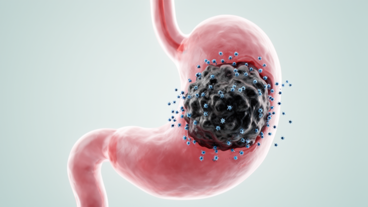 Early Tumor Shrinkage Predicts Longer Survival in Gastric Cancer Patients on Immunotherapy
