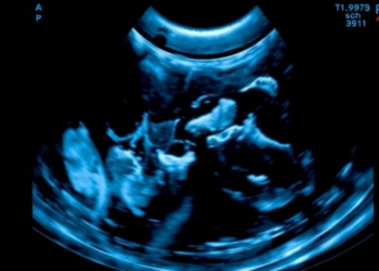 Ultrasound Scan Before Chemotherapy Predicts How Breast Tumors Will Shrink