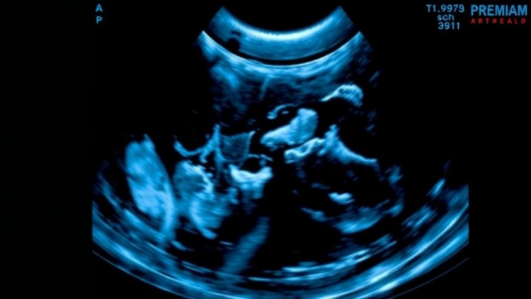 Ultrasound Scan Before Chemotherapy Predicts How Breast Tumors Will Shrink