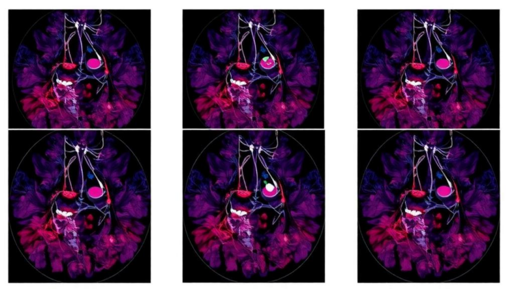 Tumor Diversity Emerges as a Hidden Driver of Chemotherapy Failure in Breast Cancer