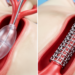 Retrospective aorto-ostial registry finds no significant difference between balloons and stents