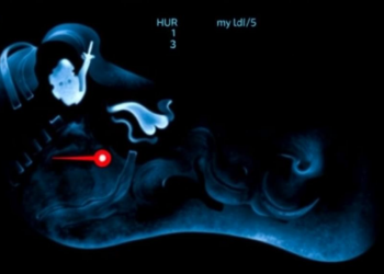 Ultrasound Falls Short in Ruling Out Bone Infection in Diabetic Foot Ulcers, Study Finds