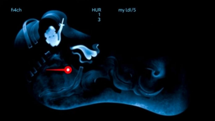 Ultrasound Falls Short in Ruling Out Bone Infection in Diabetic Foot Ulcers, Study Finds