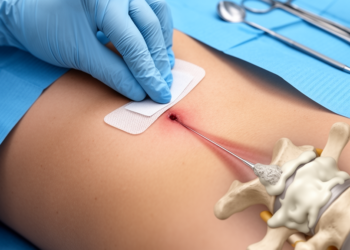 Puncture-site closure linked to early wound events after vertebroplasty