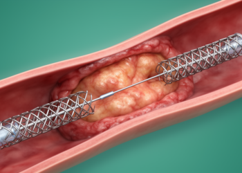 Dual bare-metal stents repair infected subclavian pseudoaneurysm in case report