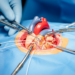 Case report describes low-impedance coronary-wire pacing during TAVR