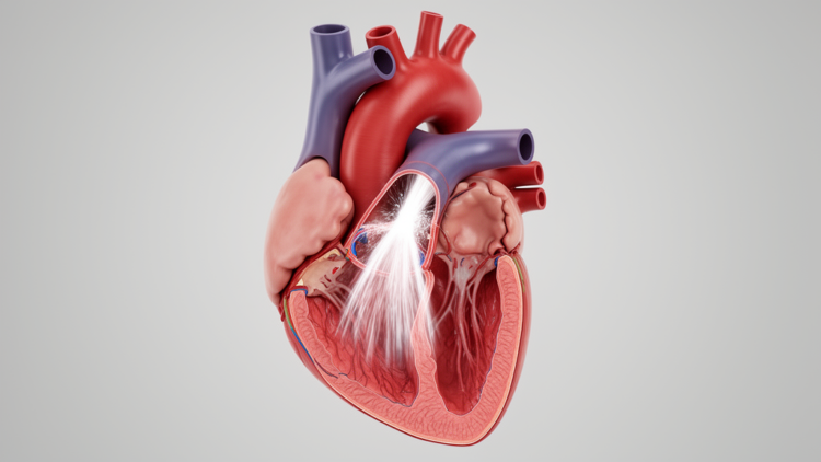 Severe aortic regurgitation: stable ventricular size, persistent risk