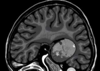 Small-cohort nnU-Net study shows promise for pediatric Wilms tumor MRI segmentation