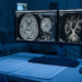 Retrospective single-center study tests venous imaging strategy in mild-to-moderate brain injury