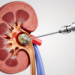 Needle-Sized Kidney Stone Surgery Shows Promise, But Superiority Not Proven