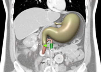 Gallbladder Fossa Depth on CT May Predict Catheter Path in Drainage Procedure