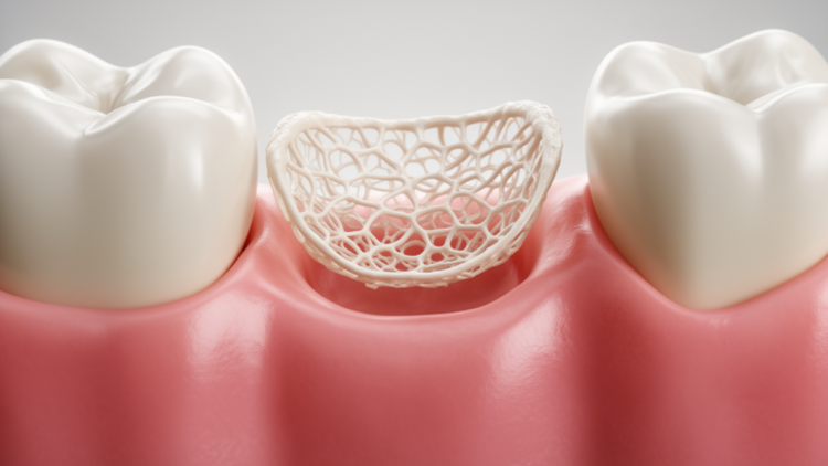 Epithelium Island Graft Technique Restores Receding Gums in Orthodontic Patients