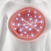 Survey links digital engagement to breast cancer registry interest