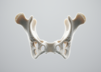 Hyoid bone CT analysis estimates sex with 93.8 percent accuracy in forensic study