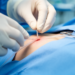 First US patients in pulmonary artery denervation trial