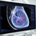 AI Reads Ultrasound to Predict Breast Cancer Spread Before Surgery