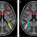 MRI-measured arterial enhancement volume flags early recurrence after liver cancer surgery