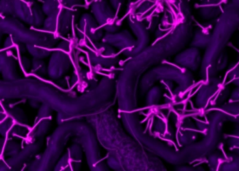 Osteopontin Fingerprints in Tissue Scans Predict Pancreatic Cancer Survival