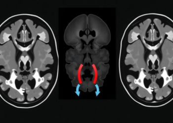 CTA Radiomics Model Distinguishes Symptomatic From Silent Vertebrobasilar Dissections