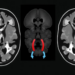 CTA Radiomics Model Distinguishes Symptomatic From Silent Vertebrobasilar Dissections