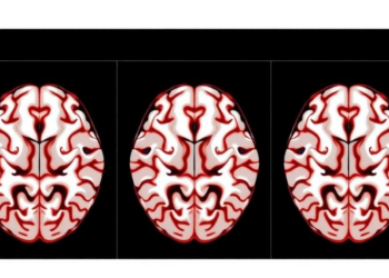 White Matter Tract Decline Tracks Cognitive Loss After Frontal Glioma Treatment