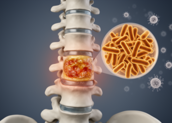 Rare Klebsiella Spinal Abscess Masqueraded as Tuberculosis in a Diabetic Patient