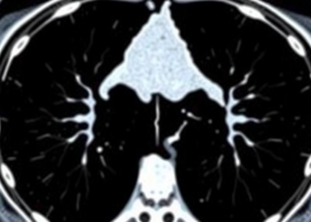 Hidden Muscle Loss on CT Scans Predicts Who Tolerates Esophageal Cancer Immunotherapy
