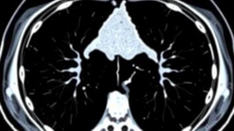Hidden Muscle Loss on CT Scans Predicts Who Tolerates Esophageal Cancer Immunotherapy