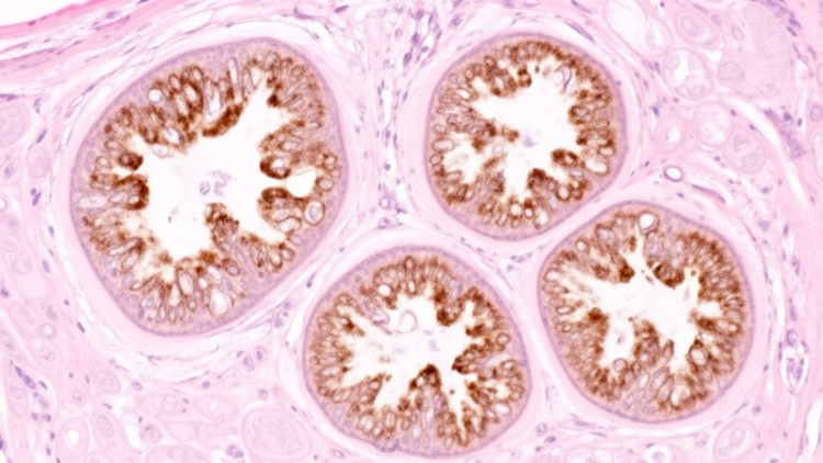 TRPC5 staining marks heterogeneous FSGS biopsy phenotype in clinical cohort