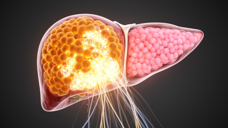 SP1-induced PDRG1 drives hepatocellular carcinoma growth via Wnt/β-catenin signaling