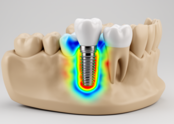 Finite-element study maps stresses around 4-mm ultra-short dental implants