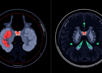 Fibrosis-Seeking PET/MRI Scan Offers Sharper Measure of Thyroid Eye Disease Activity