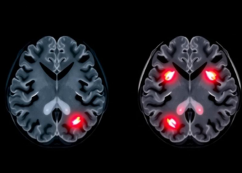 Cascaded AI Distinguishes Acceleration From Deceleration Brain Injuries on CT Scans