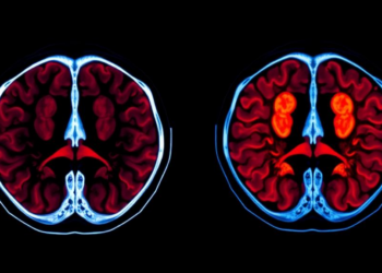PET Scans Reveal Sharply Different Sugar Appetites in Two Testicular Cancers