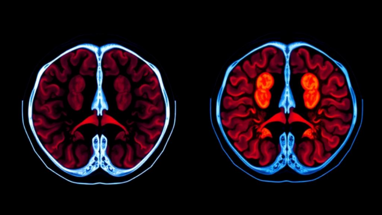 PET Scans Reveal Sharply Different Sugar Appetites in Two Testicular Cancers