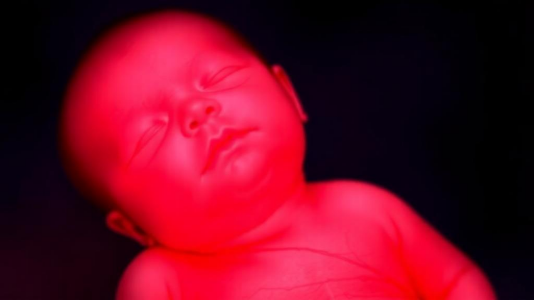 European Experts Issue First Standardized Rules for Tiny Arterial Lines in Newborns