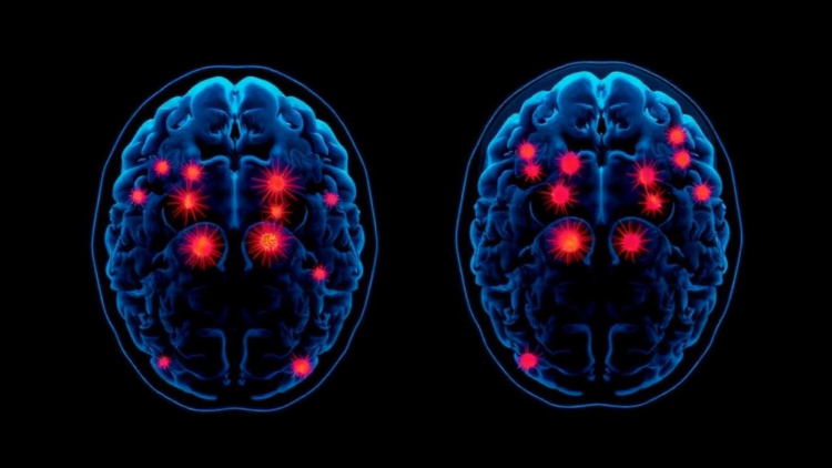Immune Cell Clusters Inside Brain Tumors Predict Glioblastoma Survival
