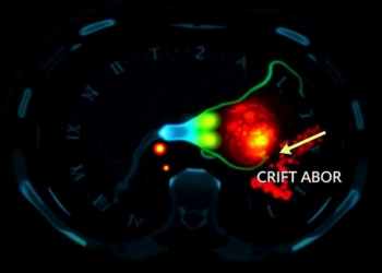 Contrast Tagging During CT Hepatic Angiography Makes Hidden Liver Tumours Glow After Ablation