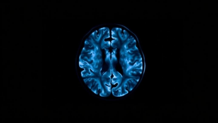 Amyloid PET Scans Predict Alzheimer’s Risk No Matter How Experts Read Them