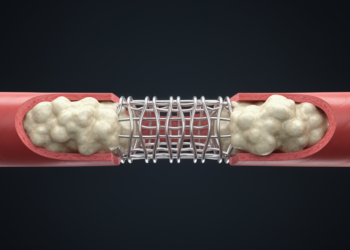 More Aggressive Calcium Clearing May Not Improve Heart Stent Outcomes
