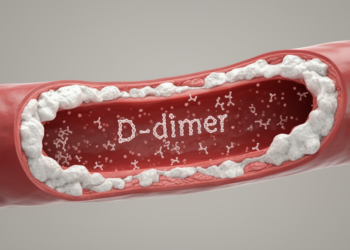 Blood Clot Marker D-dimer Linked to Artery Calcification in Dialysis Patients