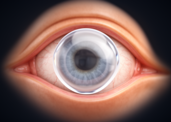 Inside the implantable collamer lens: mapping the safety limits of high-myopia surgery