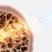Statins May Slow Bone Loss After Menopause by Rerouting Stem Cell Signals