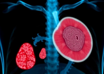 Chest Wall Mass Turns Out to Be Rare Parasitic Infection Diagnosed by Sequencing