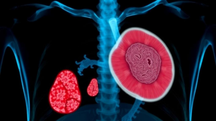 Chest Wall Mass Turns Out to Be Rare Parasitic Infection Diagnosed by Sequencing