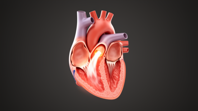 Atrial form of secondary mitral regurgitation dominates in the general population